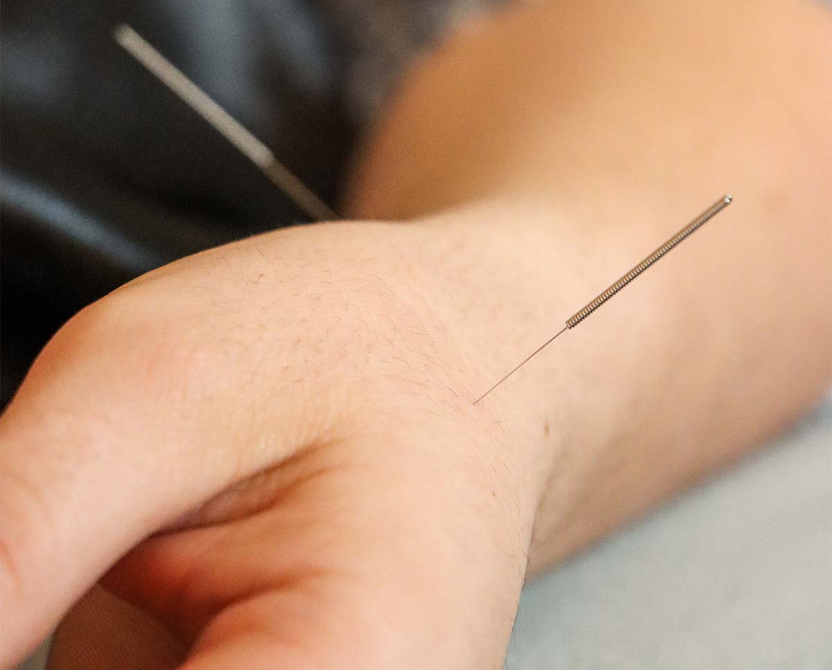 Acupuncture: Jumpstart the Body's Natural Healing Abilities
