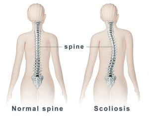 Ask the Chiropractor: Can Chiropractic Help Scoliosis?
