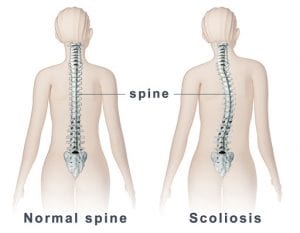 Oasis Maine - Scoliosis