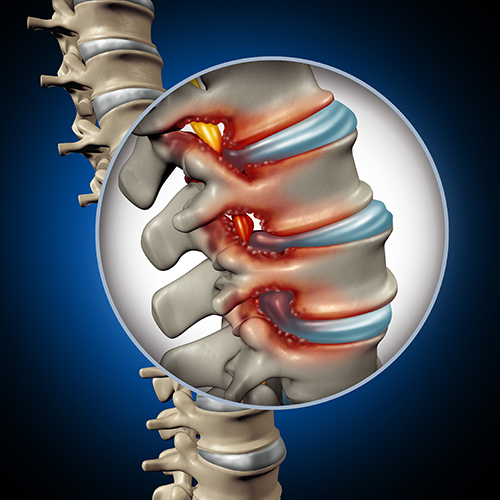Chiropractic Relief for Spinal Stenosis?