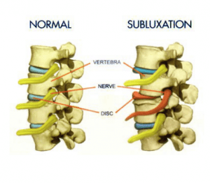 Ask the Chiropractor: How Do People Get Subluxations?